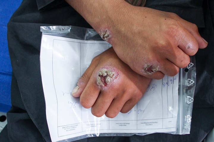 MSFの医療施設にて皮膚リーシュマニア症の治療を待つ17歳の少年。彼はサシチョウバエ(sandfly)に顔、手、足を刺されていた。© Nasir Ghafoor/MSF