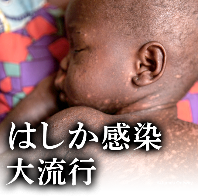 はしか感染 大流行
