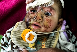 モスルで負傷した赤ちゃん。
家族で唯一生き残り、MSF病院で治療を受けた
