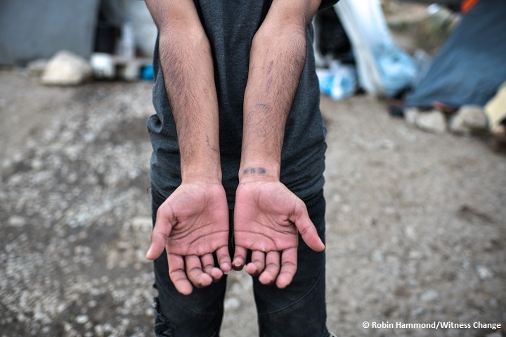 シリアから家族とともに逃れてきた55歳の男性の腕には、無数の傷が残る