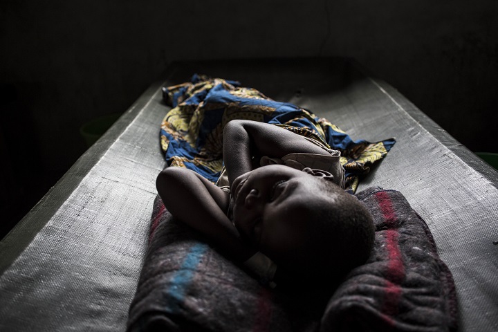 コンゴ民主共和国でMSFの治療を受ける少女　© John Wessels