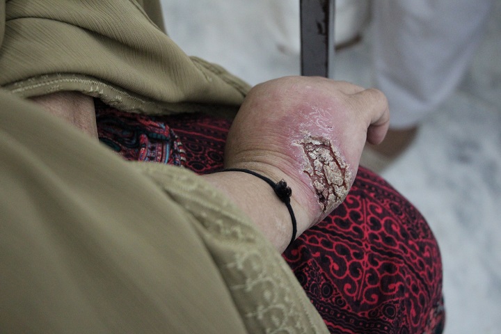 感染で手がひどく腫れ皮膚がゆがんでしまった女性　© Nasir Ghafoor MSF