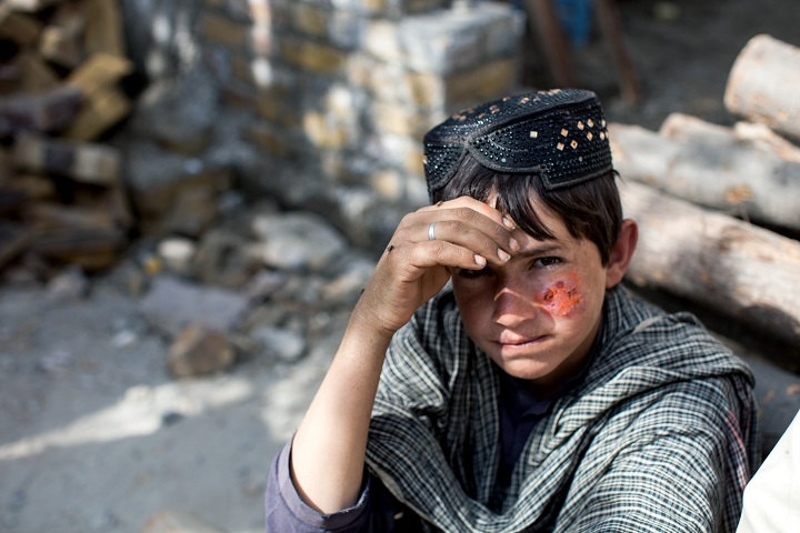 バスで3時間かけて皮膚リーシュマニア症の治療センターへ来た少年　© Khaula Jamil