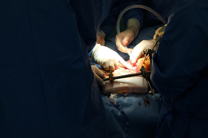 MSFの外科チームが、サリムさんの足を手術する様子。© Jacob Burns/MSF