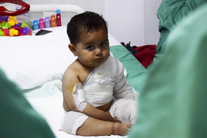 カイヤラのMSF病院では子どものやけど患者を多く治療している　© Candida Lobes/MSF