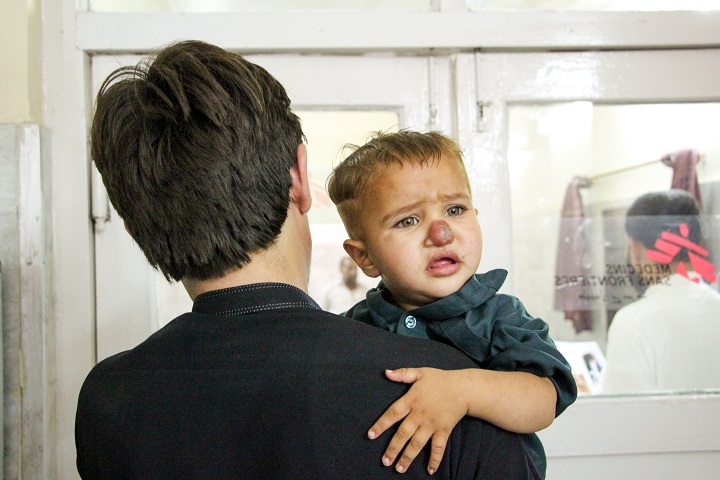 皮膚リーシュマニア症の治療を受ける2歳の男の子　© Nasir Ghafoor/MSF