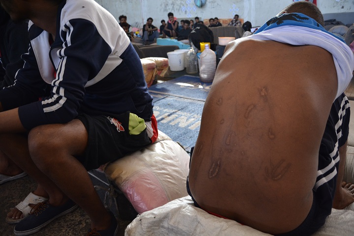 人身売買業者につけられた傷を見せる男性　© Jérôme Tubiana/MSF