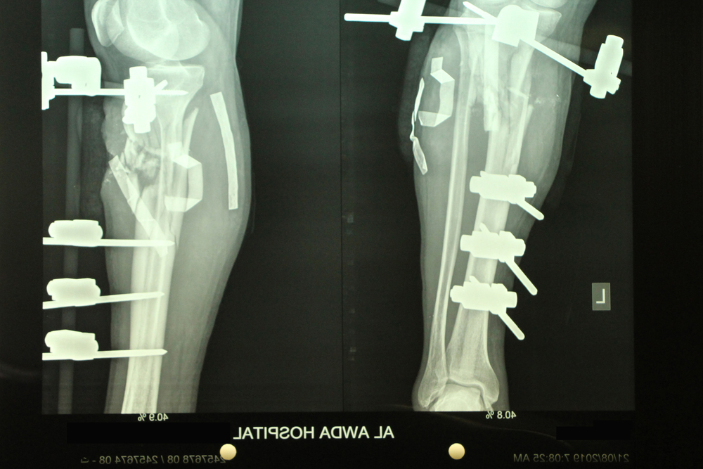 イスラエル軍に足を撃たれた患者のレントゲン写真＝2019年8月　©Jacob Burns/MSF