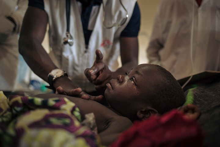 はしかに苦しむ3歳半の小児患者 © Alexis Huguet/MSF
