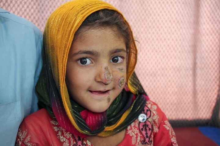 パキスタン・ペシャワールで皮膚リーシュマニア症の治療を受ける6歳の少女　© Nasir Ghafoor/MSF