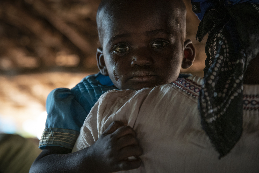 はしかに感染してMSF医療施設に来た子ども © MSF/Caroline Thirion