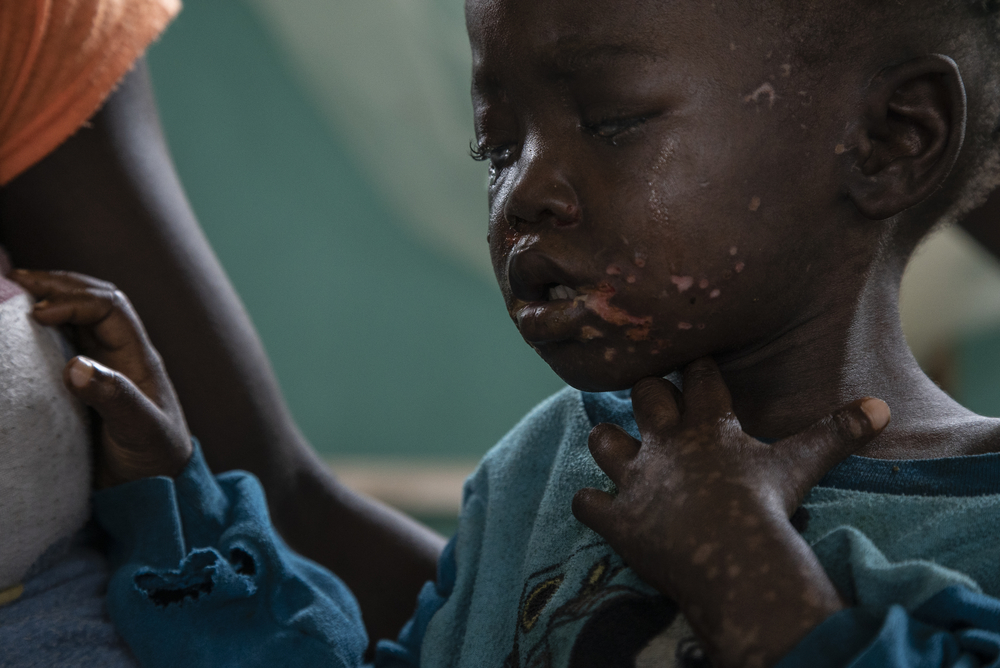 MSFチームによる治療を受けているドド・マムバンザちゃん © MSF/Caroline Thirion