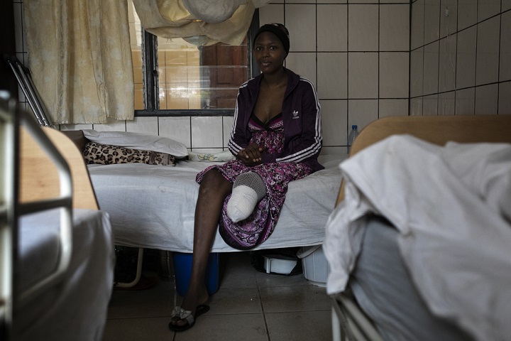 交通事故で左足を失ったオルネラさん　© Albert Masias/MSF