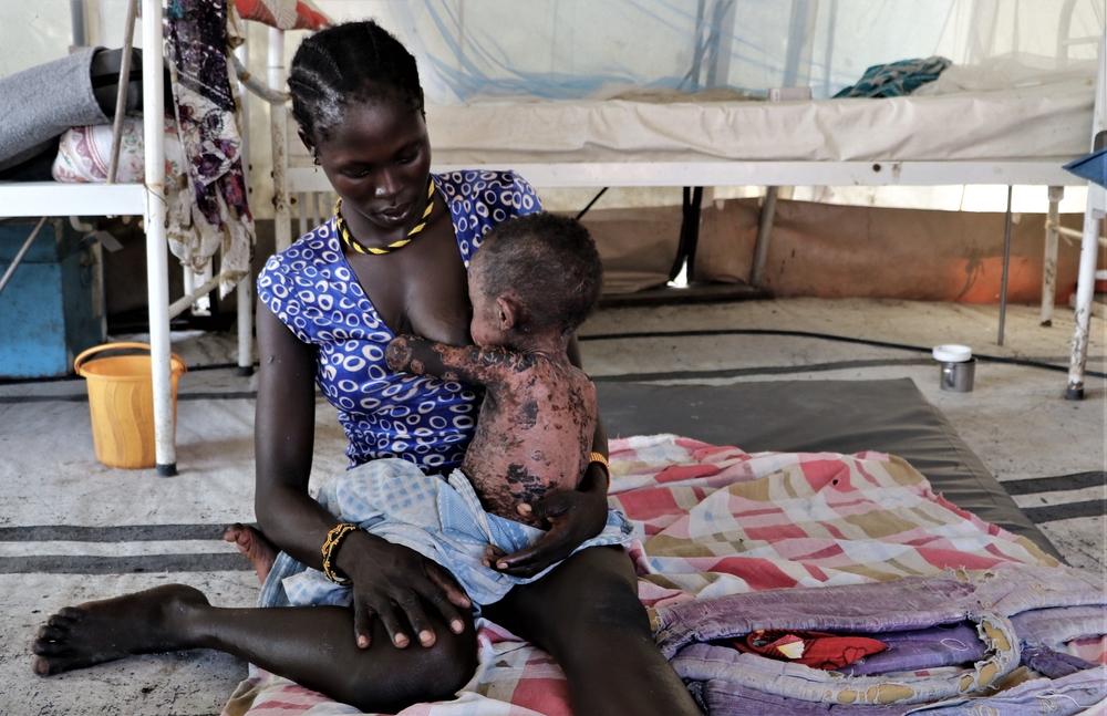 重度のはしかにかかった幼い子どもを連れてMSFの診療所を訪れた女性　© MSF/Tetiana Gaviuk