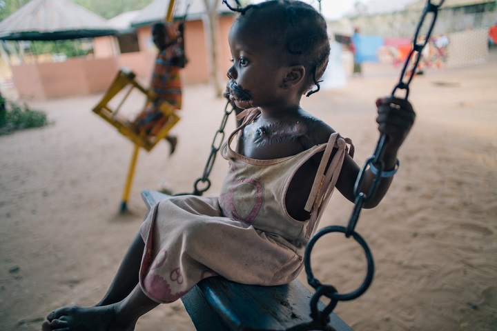 水がんを患うナイジェリアの4歳の少女＝2018年　　© Claire Jeantet - Fabrice Caterini/INEDIZ
