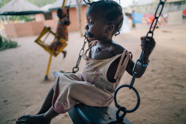 水がんを患うナイジェリアの4歳の少女=2018年 © Claire Jeantet - Fabrice Caterini/INEDIZ