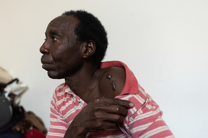 スーダン出身の男性。リビアの犯罪組織に二度誘拐され、肩にやけど跡を負う拷問を受けた。移民・難民の生活環境は非常に危険で、路上で強盗や暴力にさらされ、恐喝のために誘拐されることも多い　© Giulio Piscitelli