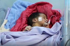 【動画】重度栄養失調の子どもも──イエメンの紛争地　その医療現場から