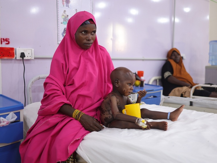 クワシオルコルの治療を受ける子ども＝2026年6月20日　© Abba Adamu Musa/MSF