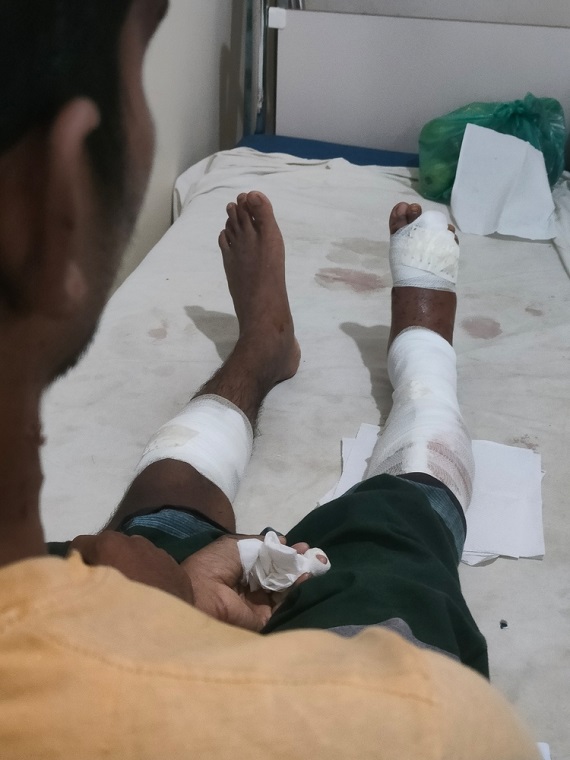 爆弾で両足を負傷したロヒンギャの男性=2024年8月14日 © MSF