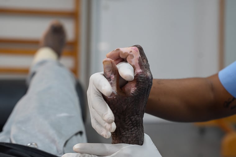 ハイチ／ポルトープランス：タバルにあるMSFの病院で、理学療法士がやけど患者の手を動かしながら機能回復を促している＝2025年3月　© Marx Stanley Léveillé/MSF