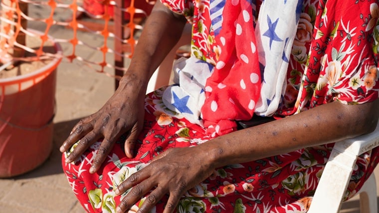 ケニア／モンバサ：エムポックスの治療を終え、残った傷跡を見せるローズ・ムタミさん＝2025年9月　© Zainab Mohammed/MSF