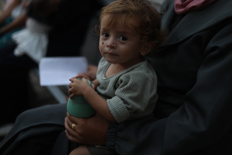 ガザにあるMSF診療所を訪れた1歳の男の子。重度の急性栄養失調に陥っており、胸部には湿疹も見られるが、食料などを購入する余裕はない＝2025年8月12日　© MSF