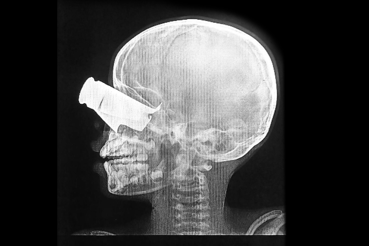 スーダン西部でドローン攻撃に遭い、目に重傷を負った9歳の男の子の検査写真。チャドの町ティネにある、MSFが支援する病院に運び込まれた＝2026年2月　© MSF