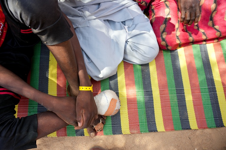 戦闘に巻き込まれ、足にけがを負った17歳の少年。家族とともにチャドの難民キャンプへ逃れ、そこでMSFの治療を受けた＝2025年6月13日　© Julie David de Lossy/MSF