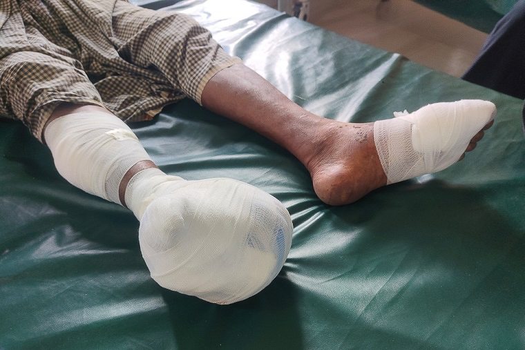 国境を越え、バングラデシュへ入国する際に爆発で足を失ったロヒンギャの男性＝2024年8月14日　© MSF