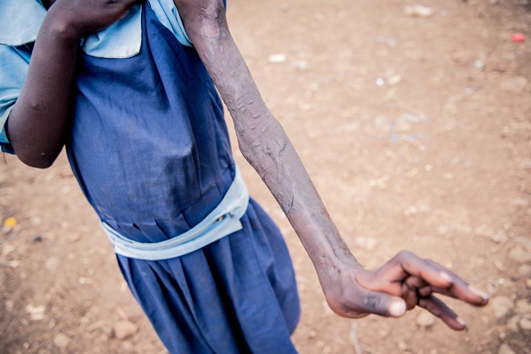 ヘビ咬傷で手が変形してしまったケニアの女の子　© Paul Odongo/MSF