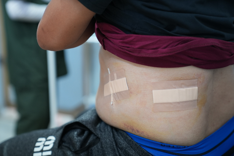 MSFスタッフのアシュラフに残る、イスラエル軍の銃撃による傷痕＝2026年6月14日　© MSF