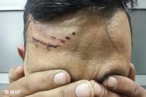 写真の男性は国境近くで仲間と一緒に眠っていたところ、目に催涙スプレーを吹きかけられた。