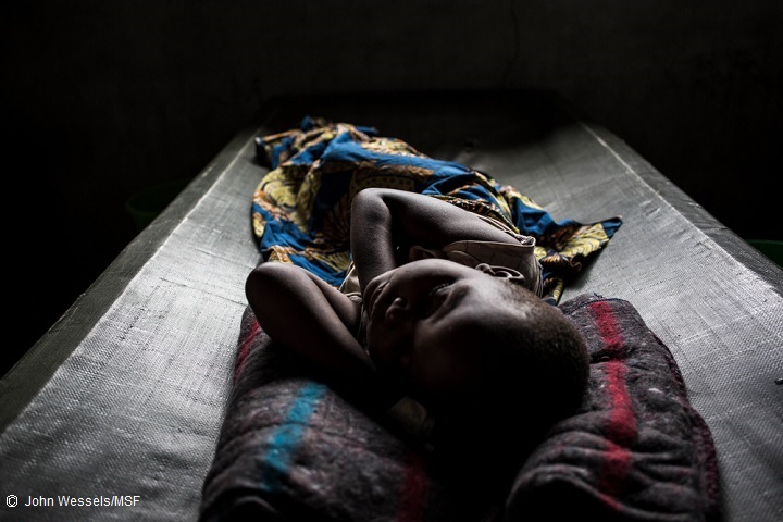 MSFのコレラ治療センターで治療を受ける少女