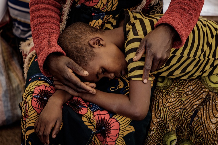 コレラに感染し診療所を訪れた少女（コンゴ民主共和国）=2022年6月　 © Michel Lunanga/MSF