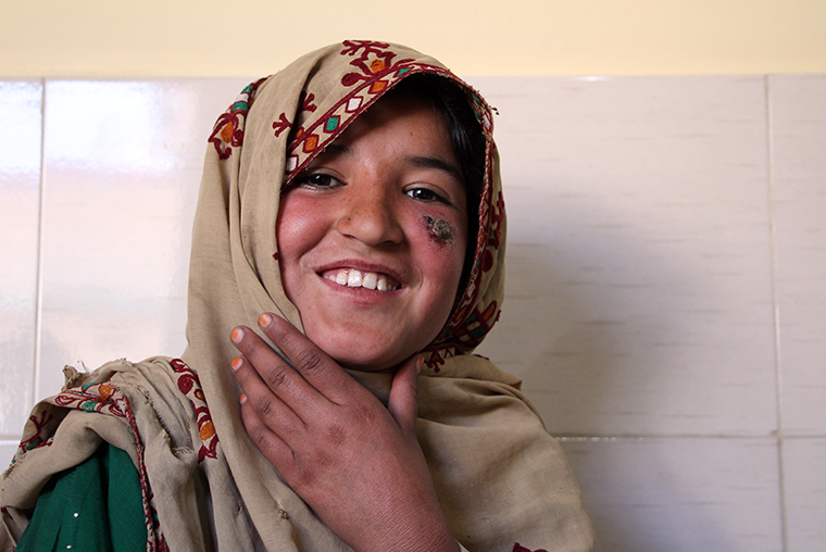 皮膚リーシュマニア症で顔に傷跡が残った少女。友達からからかわれて苦しむことも=2021年、パキスタン　© Zahra Shoukat/MSF