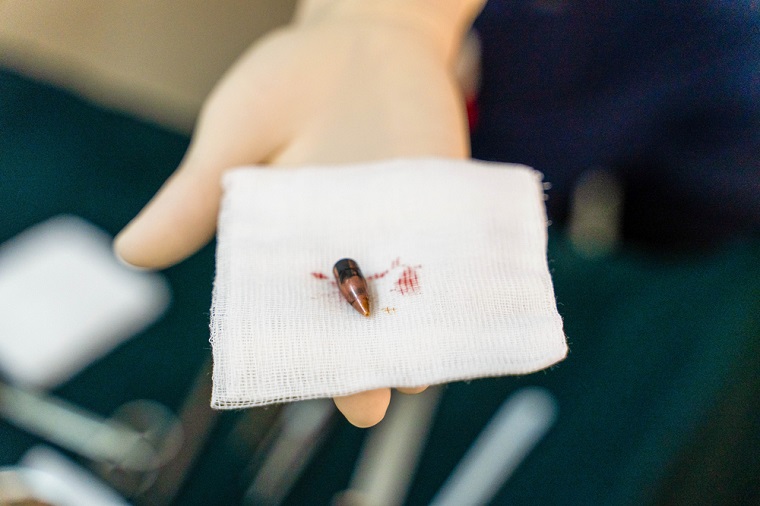 外科手術によって負傷者の体内から取り出された弾丸　© MSF/Ala Kheir 