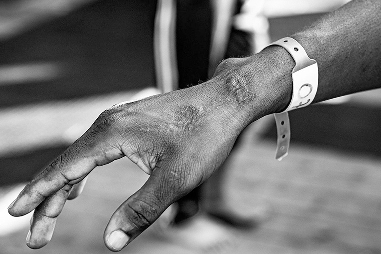 収容センターにて鉄パイプで殴打された男性　© MSF/Candida Lobes 