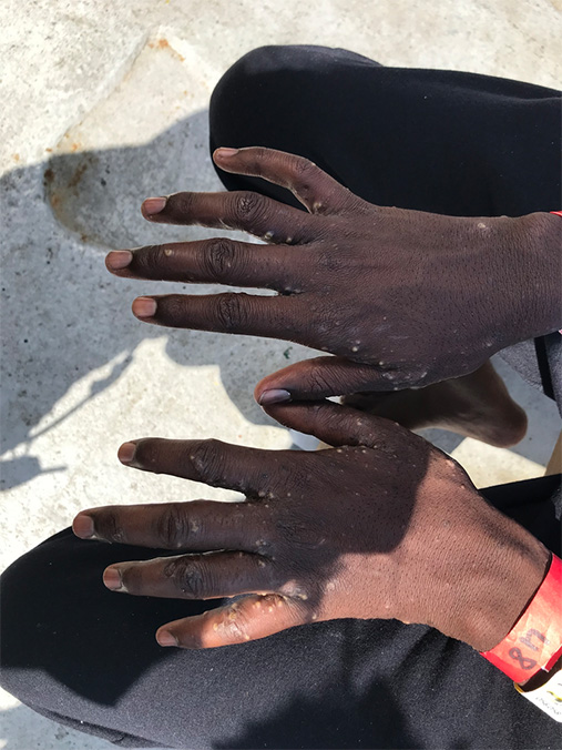 収容センター内の不衛生な環境下で皮膚病にかかった男性　© Lauren King/MSF 