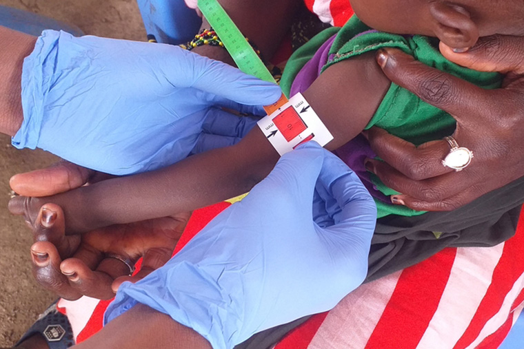 栄養失調の深刻さをすぐに判断するため、「命のうでわ」を使って子どもの二の腕の太さを測る　Ⓒ MSF/Suleiman Hassan