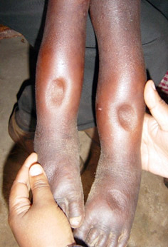タンパク質不足による足の浮腫。指で押すと<br> へこんだままになる　© Akiko Matsumoto/MSF
