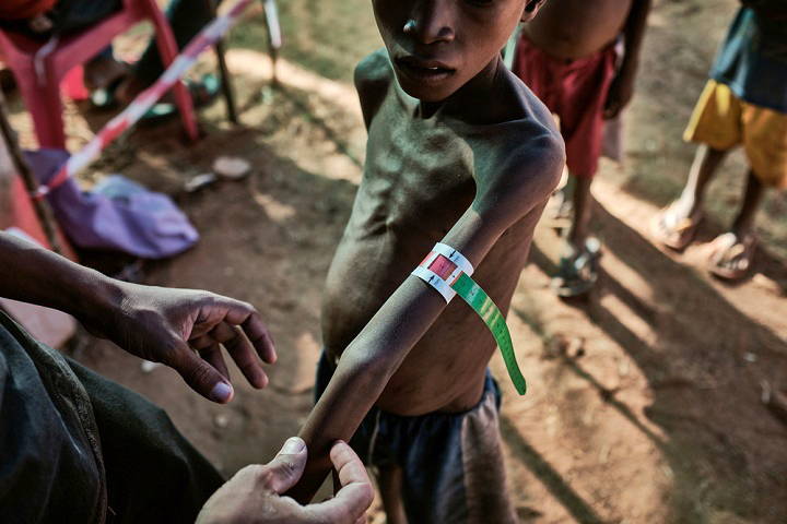 マダガスカル、栄養失調の状態を確認するため子どもの上腕周囲を測定する　© iAko M. Randrianarivelo/Mira Photo