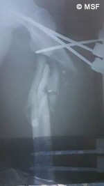 アブー・アフメドさんの脚のレントゲン写真