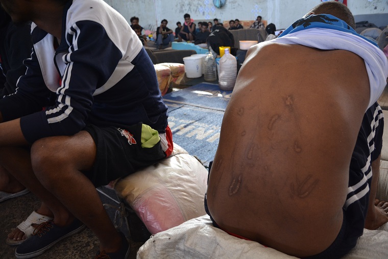リビアの収容センターにて、人身売買業者に監禁されている間に負った傷跡を見せる移民＝2019年6月16日　© Jérôme Tubiana/MSF